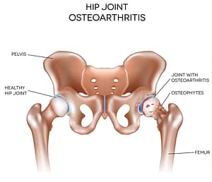 osteoarthritis of the hip